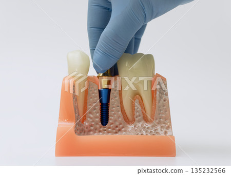 Dental implant integration model held by gloved hand Dental implant integration model held by gloved hand 135232566