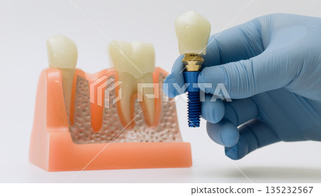 Gloved hand holding dental implant next to jaw model 135232567
