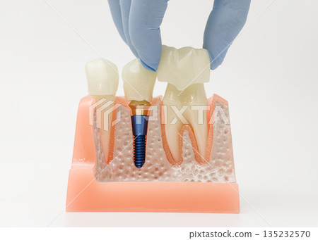 Placing dental crown on implant model in jaw 135232570