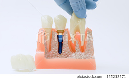 Hand holding extracted tooth above dental implant model 135232571