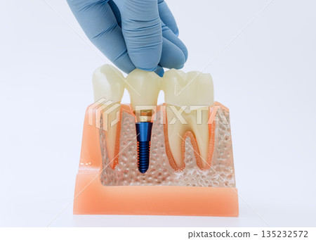 Placing crown on dental implant in gum model 135232572