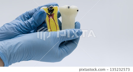 Dental models showing tooth decay and cross-section anatomy 135232573