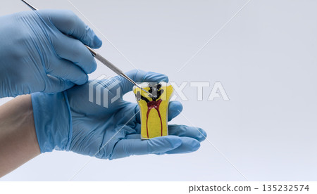 Dentist pointing at decayed tooth model with explorer Dentist pointing at decayed tooth model with explorer 135232574