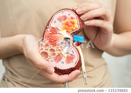 Chronic kidney disease, Asian woman with model for treatment urinary system, urology, Estimated glomerular filtration rate eGFR. Chronic kidney disease, Asian woman with model for treatment urinary system, urology, Estimated glomerular filtration rate eGFR. 135239885