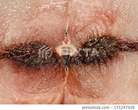 Clinical view of irritated naval area with infection signs 135247926