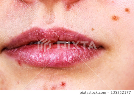 Female face with acne skin problem 135252177