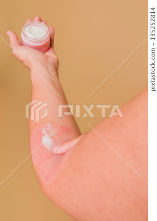 Woman applying cream to irritated skin area 135252814