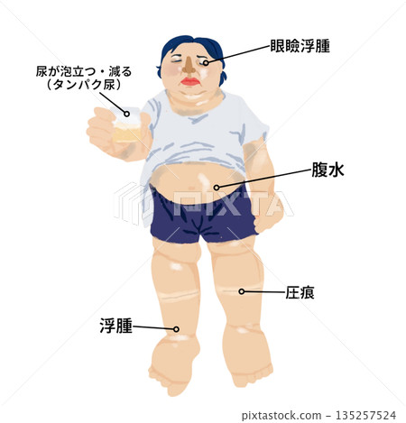 腎病症候群症狀示意圖 | 患者表現為全身水腫、眼瞼水腫、腹水及蛋白尿 腎病症候群症狀示意圖 | 患者表現為全身水腫、眼瞼水腫、腹水及蛋白尿 135257524