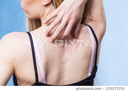 Woman with skin problem acne on back Woman with skin problem acne on back 135275701