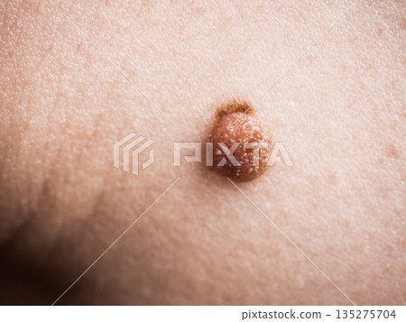 Skin with dark fibroma. Close up of papilloma dermatosis 135275704