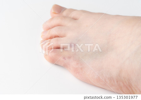 Close-up of a bruised little toe 135301977