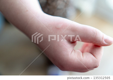Macro photography of a child's skin with a characteristic red spot and swelling following a mosquito bite or allergic reaction. Concept of childhood diseases, dermatology, and first aid. 135312505