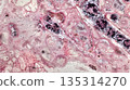 Photo of a biopsy sample under a microscop 135314270