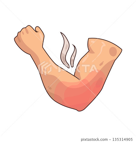 illustration of Inflamed Elbow illustration of Inflamed Elbow 135314905