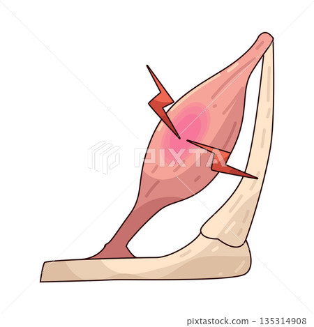 illustration of Muscle Ache illustration of Muscle Ache 135314908