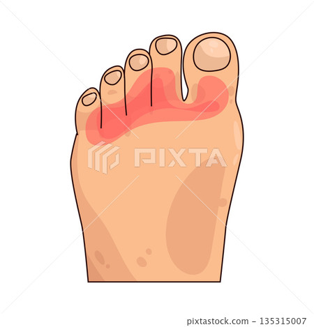 illustration of Toe Pain 135315007