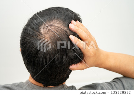 Bald in the middle head and begin no loss hair glabrous of mature man. 135329852