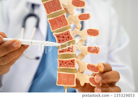 Doctor holding osteoporosis in back bone model for treatment medical in orthopedic department. 135329853