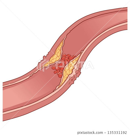 blocked artery with yellow cholesterol plaque buildup and a red blood cell clot blocked artery with yellow cholesterol plaque buildup and a red blood cell clot 135331192