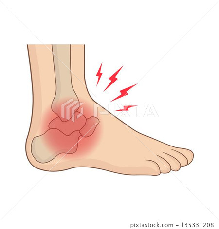 Medical anatomical illustration of a human foot with red inflamed ankle joint Medical anatomical illustration of a human foot with red inflamed ankle joint 135331208