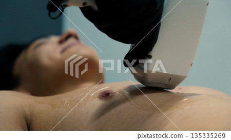Man receiving laser treatment on chest Man receiving laser treatment on chest 135335269