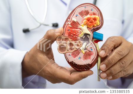 Kidney disease, Chronic kidney disease ckd, Doctor hold human model. 135380535