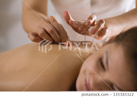 The doctor sticks needles into the woman's body on the acupuncture - close up 135383322