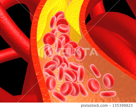 Clogged Arteries on scientific background Clogged Arteries on scientific background 135399823