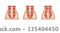 Different stages of diastasis recti showing abdominal muscles separation 135404450