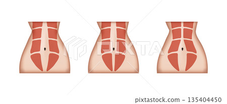 Different stages of diastasis recti showing abdominal muscles separation 135404450