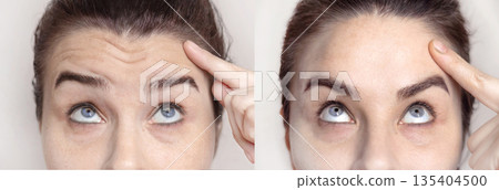 Collage with portraits Caucasian woman with wrinkles on the forehead and between her nose and portrait after visiting a beautician. Botox injections, dysport. Folds on the skin. Close up photo 135404500