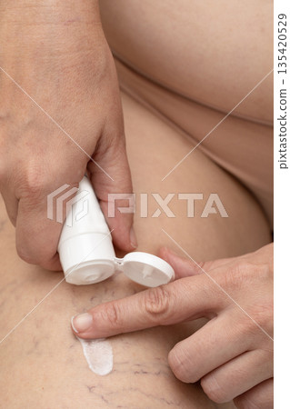 Woman's hand applying skin care cream to her legs with visible varicose veins. Real body, natural skin texture. Concepts of self-care, body positivity, realistic beauty standards 135420529