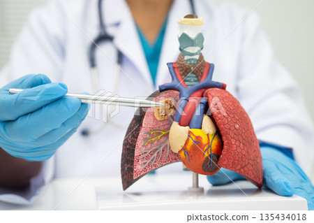 Pneumonia, lung cancer, Asian doctor holding human model. 135434018