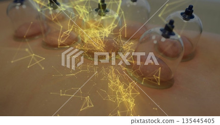 Woman receiving cupping therapy on massage table, with suction cups and glowing digital overlay Woman receiving cupping therapy on massage table, with suction cups and glowing digital overlay 135445405