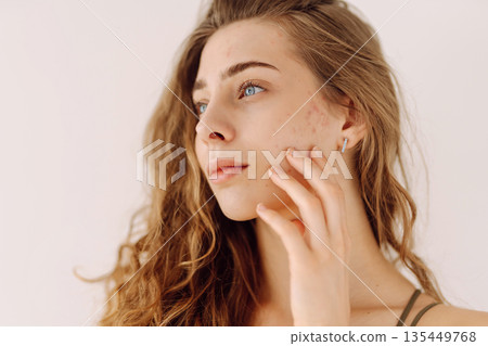 Portrait of a beautiful young woman with inflammations on the skin of her face. Acne disease. Portrait of a beautiful young woman with inflammations on the skin of her face. Acne disease. 135449768