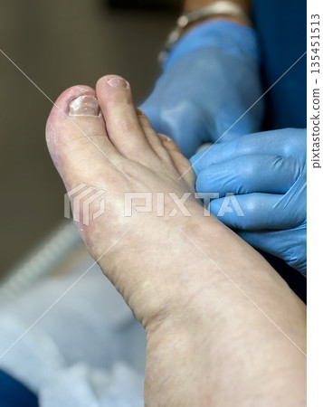 Hardware medical pedicure using a drill and nail files. A patient has a pedicure at a podiatrist. A dangerous fungal lesion of human toenails. Onychomycosis, treatment of nail fungus. 135451513