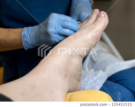 Hardware medical pedicure using a drill and nail files. A patient has a pedicure at a podiatrist. A dangerous fungal lesion of human toenails. Onychomycosis, treatment of nail fungus. 135451515