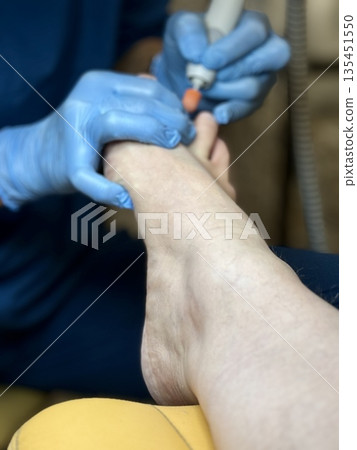 Hardware medical pedicure using a drill and nail files. A patient has a pedicure at a podiatrist. A dangerous fungal lesion of human toenails. Onychomycosis, treatment of nail fungus. 135451550