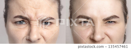 Collage with portraits Caucasian woman with wrinkles on the bridge of her nose and between the eyebrows and portrait after visiting a beautician. Botox injections, dysport. Folds on the skin. Close up 135457461