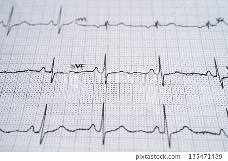 Electrocardiogram (ECG), heart wave, heart attack, cardiogram report. Electrocardiogram (ECG), heart wave, heart attack, cardiogram report. 135471489