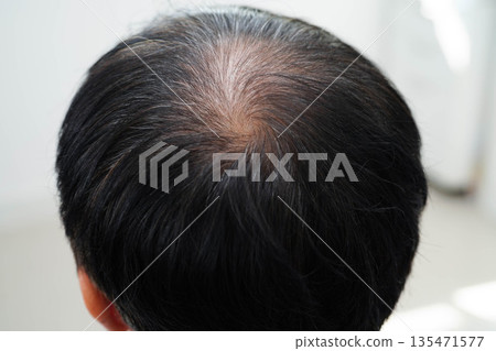 Bald head in man, hair loss treatment health problem. Bald head in man, hair loss treatment health problem. 135471577