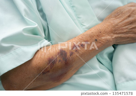 Ecchymosis, elderly bleeding on her arm after taking aspirin. Ecchymosis, elderly bleeding on her arm after taking aspirin. 135471578