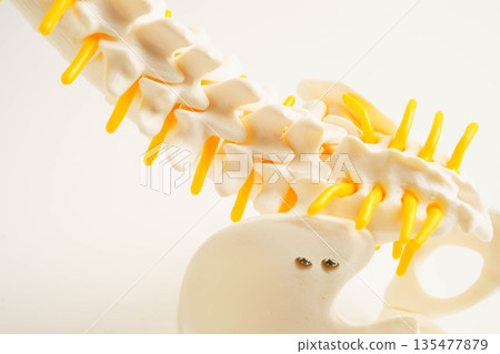Spinal nerve and bone, Lumbar spine displaced herniated disc fragment, Model for treatment medical in the orthopedic department. Spinal nerve and bone, Lumbar spine displaced herniated disc fragment, Model for treatment medical in the orthopedic department. 135477879