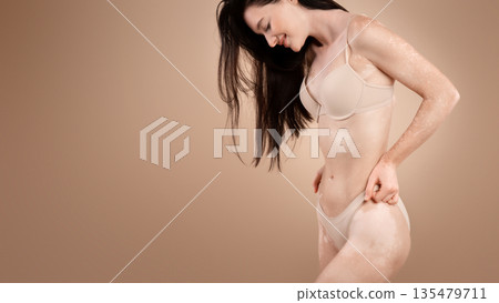 Young slim woman with vitiligo skin disorder posing in underwear over beige studio background, enjoying her beautiful body, copy space Young slim woman with vitiligo skin disorder posing in underwear over beige studio background, enjoying her beautiful body, copy space 135479711