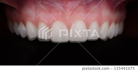 Before and after dental prosthetic correction with six ultra thin ceramic veneers Before and after dental prosthetic correction with six ultra thin ceramic veneers 135491075