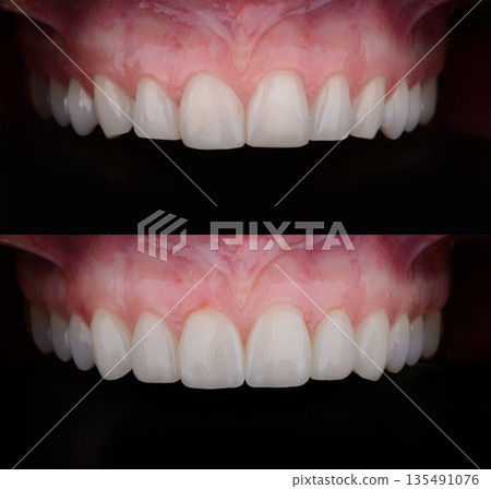 Before and after dental prosthetic correction with six ultra thin ceramic veneers 135491076