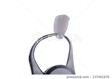 The thickness of a ceramic veneer is measured with a micrometer. Ultra-thin veneer is 0.2 mm thick. The thickness of a ceramic veneer is measured with a micrometer. Ultra-thin veneer is 0.2 mm thick. 135491876
