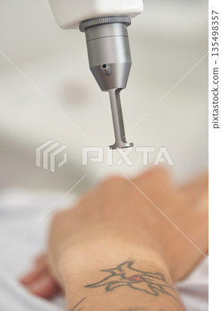 Laser tattoo removal procedure on caucasian male s wrist with star tattoo Laser tattoo removal procedure on caucasian male s wrist with star tattoo 135498357