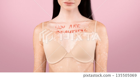 You are beautiful motivational inscription on chest of skinny woman with vitiligo disorder, young female with skin depigmentation standing in bra over beige background, cropped image with free space You are beautiful motivational inscription on chest of skinny woman with vitiligo disorder, young female with skin depigmentation standing in bra over beige background, cropped image with free space 135505069