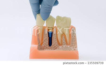 Gloved hand placing crown on dental implant model 135509739